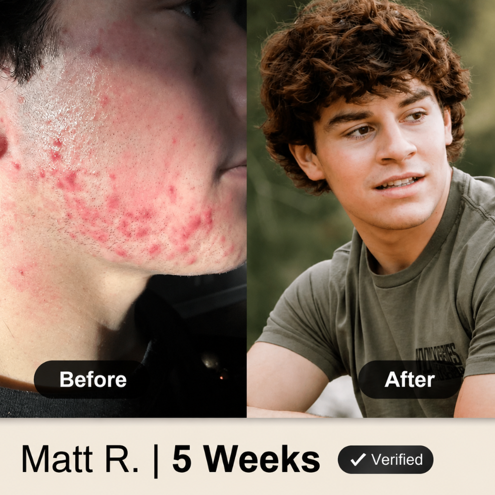 Londira Clear Skin System