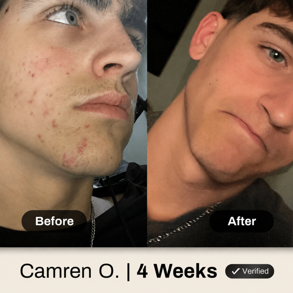 Londira Clear Skin System